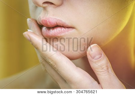 Woman Applying Ointment On Her Upper Lip With Herpes. Medical Background Of A Young Beautiful Woman 