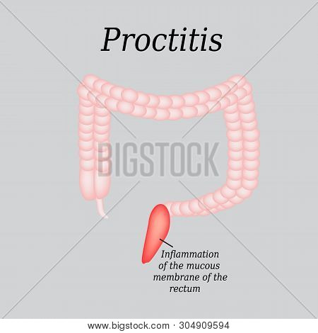 Colon. Proctitis. Vector Illustration On A Gray Background