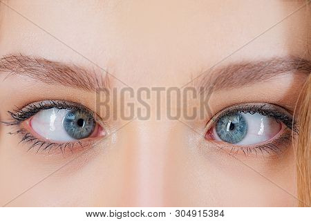 Strabismus Eye Surgery. Close Up Of Crazy Female Eyes With Squint. Eye Muscle Recession. Extraocular