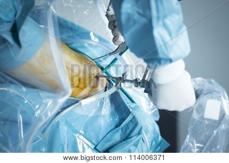 Knee Arthroscopy Orthopedic Surgery Operation