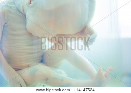 Fetus in formalin solution