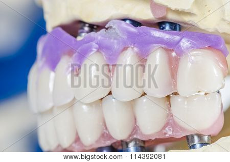 Dental Prosthesis Porcelain Teeth.