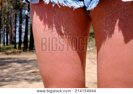 Sunburnt On Skin