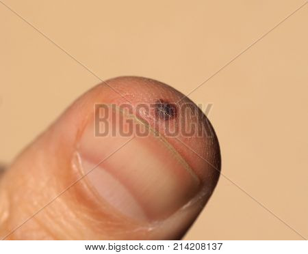 blood blister on finger injuried with an accidental hammer blow