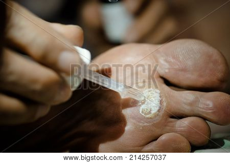 light from LED lighting focus about treatment wart on foot by salicylic acid.