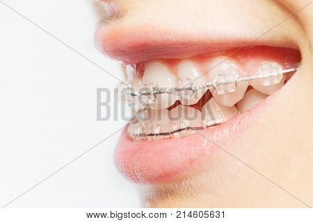 Close-up picture of teeth with clear dental braces against blanked background