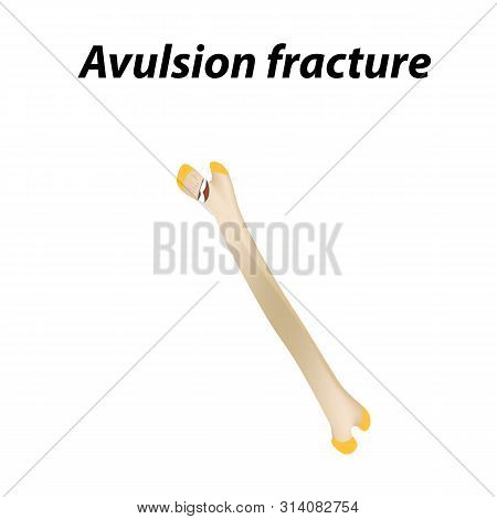 Avulsion Fracture Bone. Infographics. Illustration On A Lined Background.