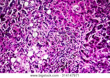 Histopathology Of Biliary Liver Cirrhosis, Light Micrograph, Photo Under Microscope