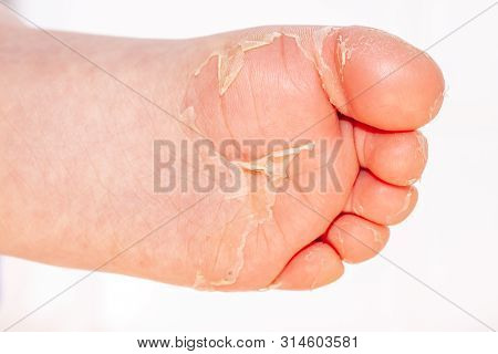 After The Red Rash And The Strawberry Tongue Caused By Scarlet Fever The Affected Skin Often Peels -