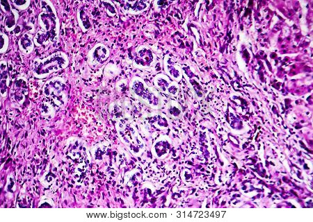 Histopathology Of Biliary Liver Cirrhosis, Light Micrograph, Photo Under Microscope