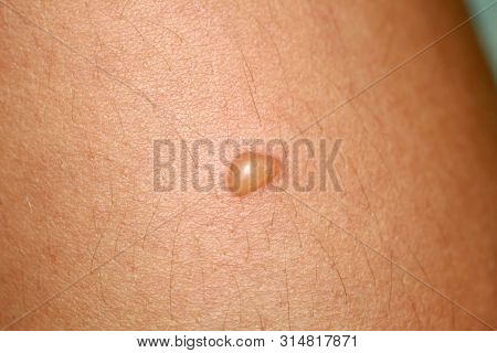 Bubble On The Skin. Blister On The Skin.