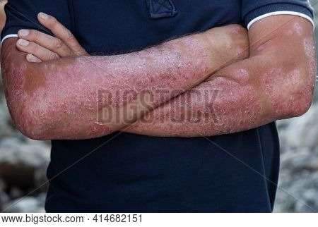 Diseases Caused By Abnormalities Of The Lymph. Psoriasis Is A Skin Disease