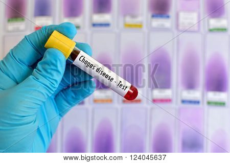 Blood sample for Chagas disease (American trypanosomiasis) test