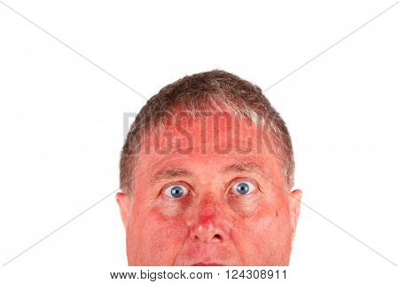 Man with a sunburned face