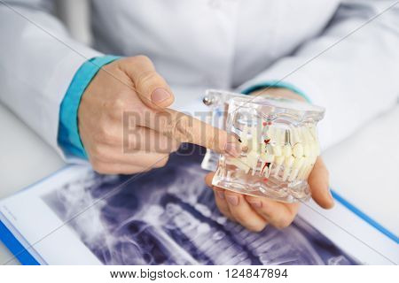 Close-up of dentist finger pointing at tooth root on jaw model. Female hygienist working in clinic.