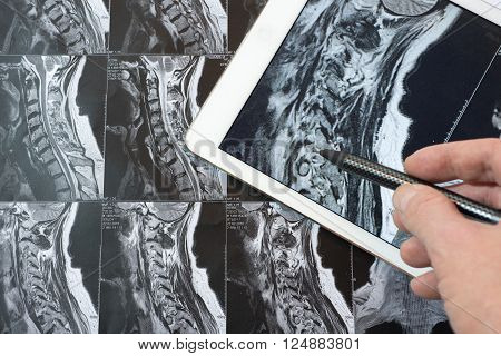 MRI Pictures of spinal column , Doctor pointing to the problem