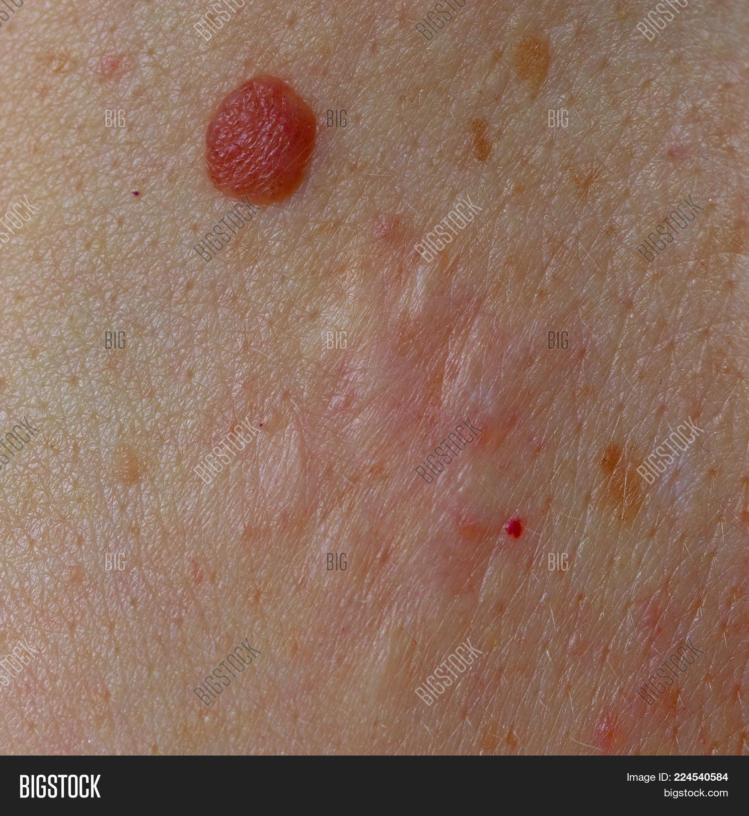 Close Mole Keloid Scar Image & Photo (Free Trial) Bigstock