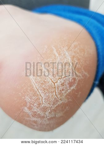 The heel of foot with bad skin is covered with cracks. The concept using medical treatment with moisturizers and also vedekure and peeling of wound healing and pain while walking swatch dermatologist