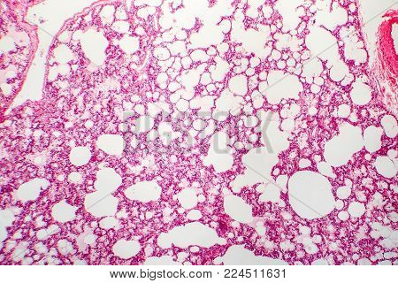 Histology of human lung tissue. Light micrograph showing alveoli, hematoxylin and eosin staining