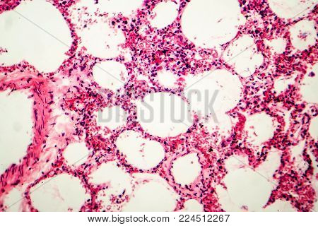 Histology of human lung tissue. Light micrograph showing alveoli, hematoxylin and eosin staining