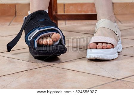 Woman Legs, One In Bandage And Orthopedic Boot After Trauma Or Surgery, With Iodine Spots.  The Resu