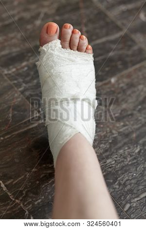 Woman Leg In White Medical Bandages, The Result Of Trauma Or Surgery, With Iodine Spots And Peach Pe
