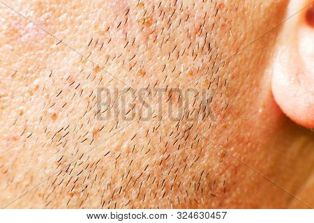 Male Stubble Close. Unshaven Male Cheek. Unshaven Face Of A Man