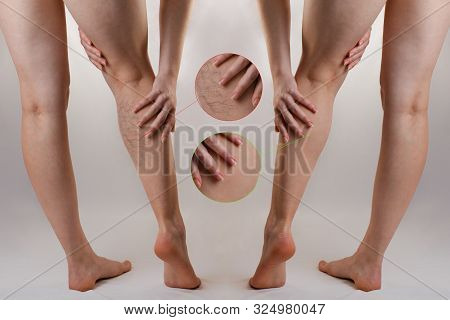 Medicine And Health. The Concept Of Female Varicose Veins. The Woman Put Her Hand To The Bad Leg Wit