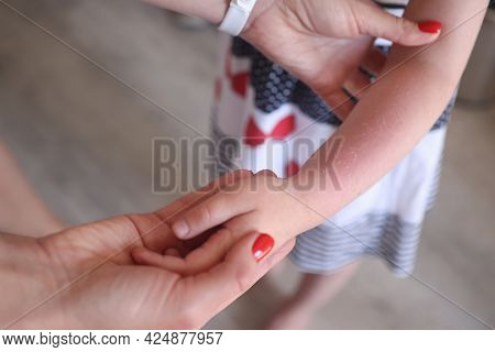 Sunburn Redness And Peeling Of Skin On Child Hand Closeup