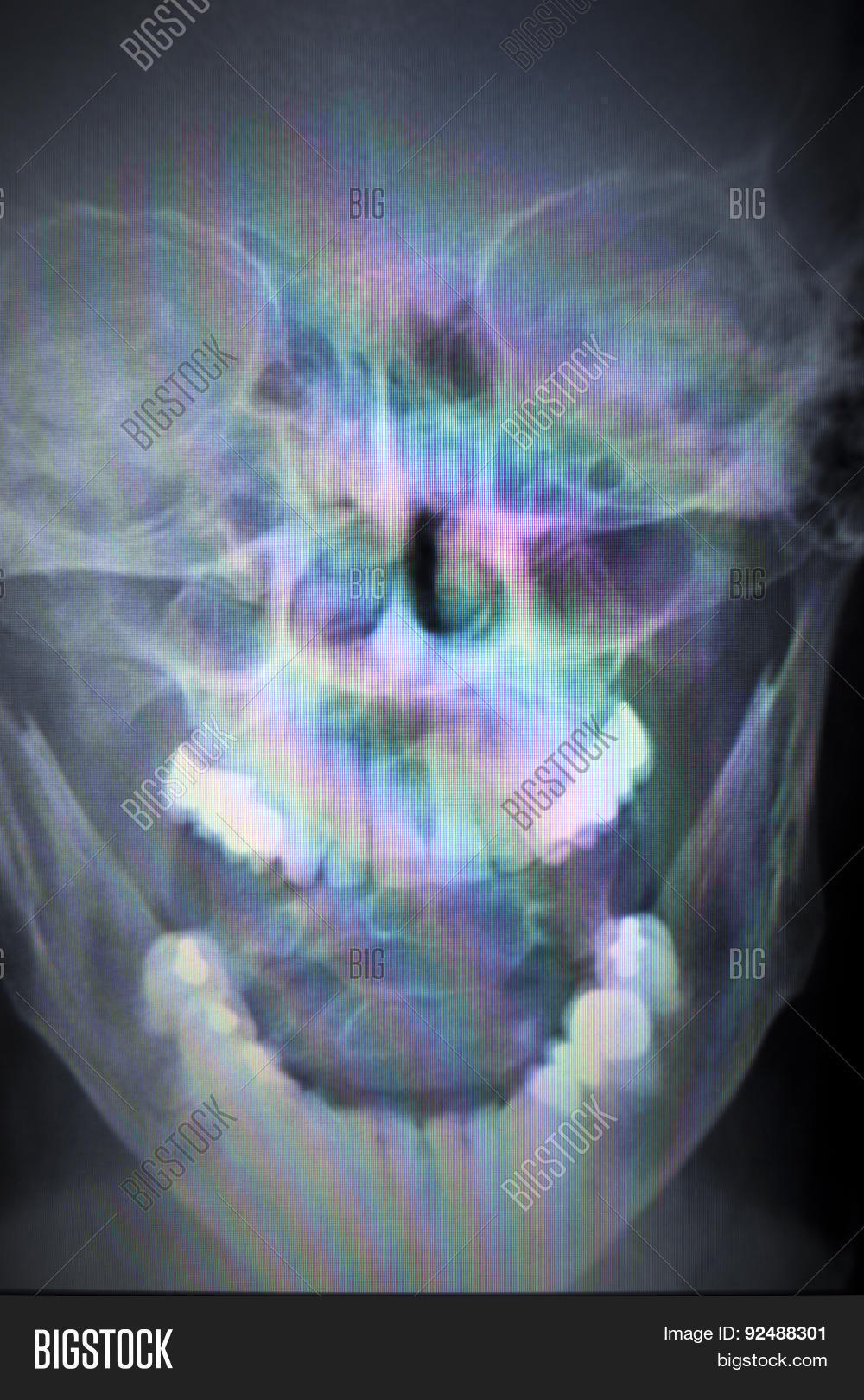 Xray Orthopedics Image & Photo (Free Trial) Bigstock