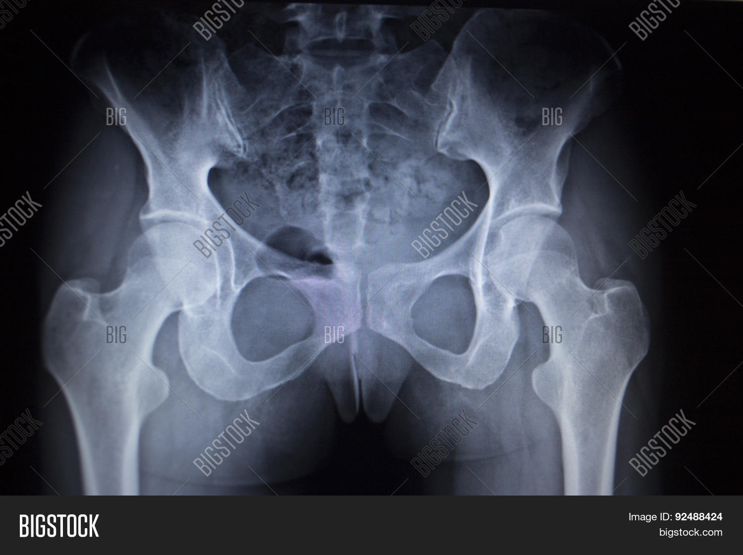 Xray Orthopedic Scan Image & Photo (Free Trial) Bigstock