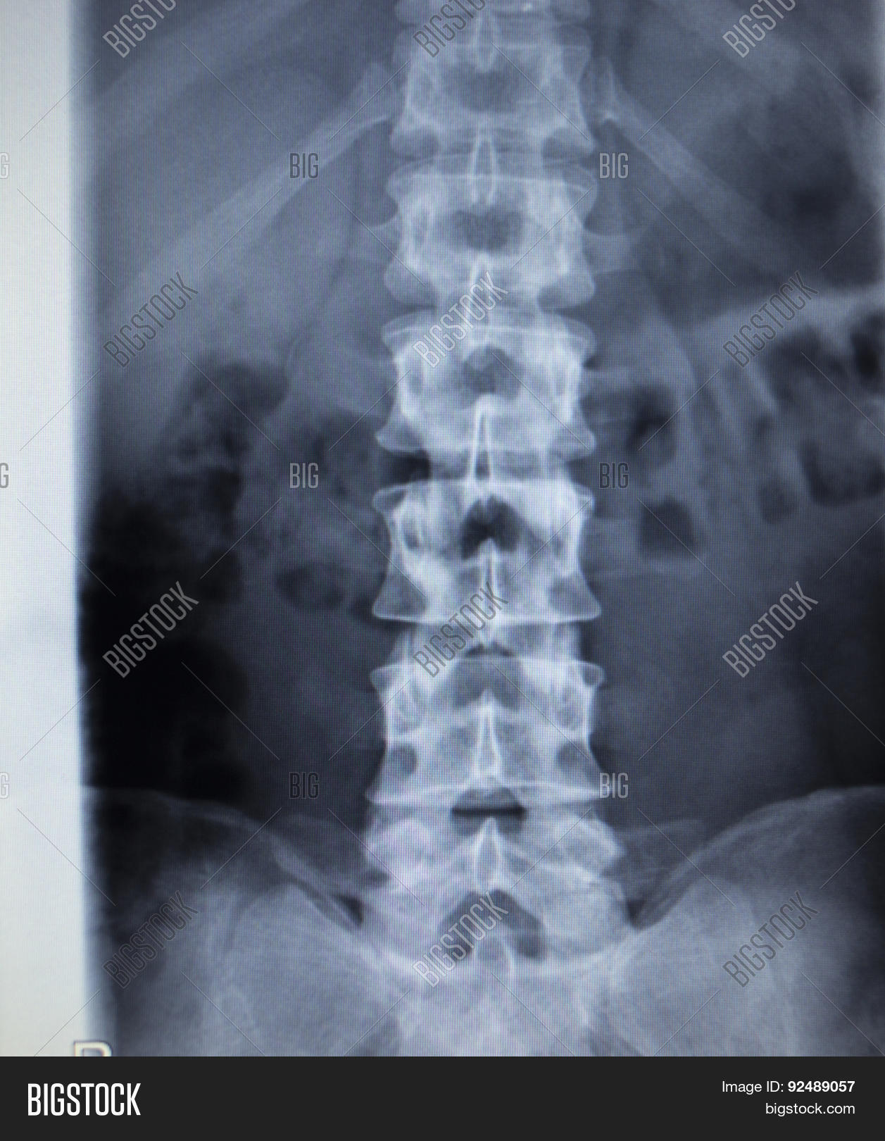 Xray Orthopedics Image & Photo (Free Trial) Bigstock