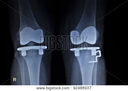 X-ray Orthopedics Scan Of Knee Meniscus Implant Prosthetics
