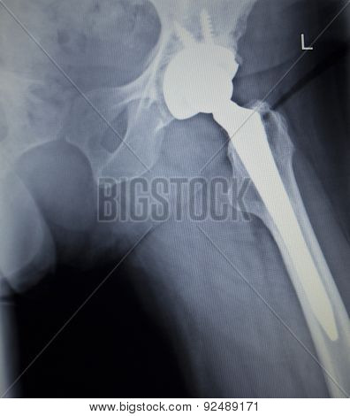 X-ray Scan  Image Of Hip Joint Replacement Orthopedic Implant