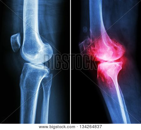 normal knee ( left image ) and osteoarthritis knee ( right image ) ( lateral view )