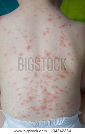 A baby boy showing his back with chicken pox