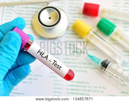 Blood sample for HLA (Human Leukocyte Antigen) test