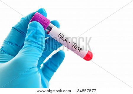 Blood sample for HLA (Human Leukocyte Antigen) test