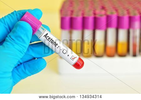 Blood sample positive with acetone chemical testing