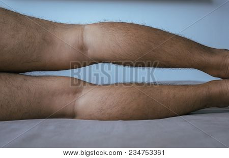 Asian Man Leg Bandy-legged Shape Of The Legs