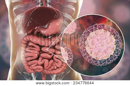 Rotaviruses In Small Intestine, 3d Illustration. Rotaviruses Are Rna Viruses The Causative Agent Of 
