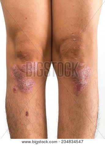 Psoriasis That Knee On White Background, Studio Shot.