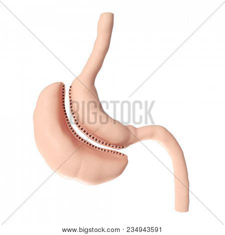 3d rendered medically accurate illustration of a vertical sleeve gastrectomy