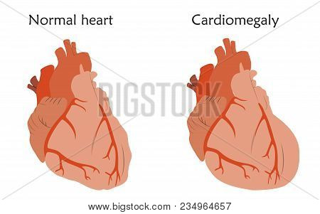 Cardiomegaly. Enlarged And Normal Heart Muscles. Anatomy Flat Illustration. Colorful Image, White Ba