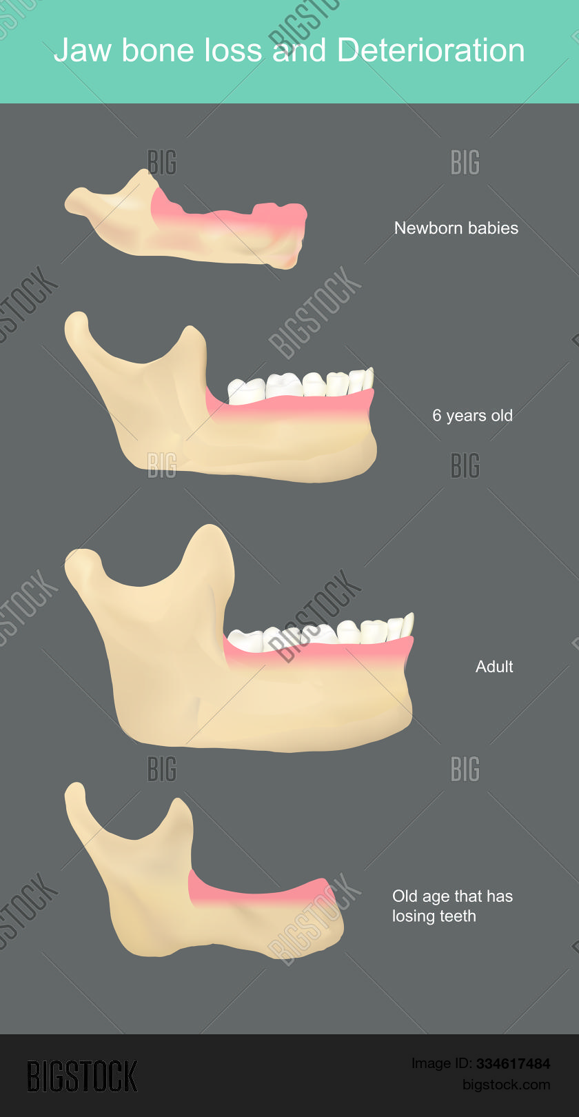Jaw Bone Loss Vector & Photo (Free Trial) Bigstock