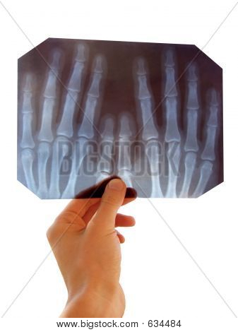roentgenogram (X-ray)