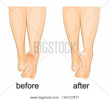 illustration of a female feet cracked heels and healthy