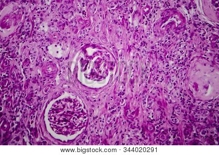 Chronic Glomerulonephritis, Light Micrograph, Photo Under Microscope