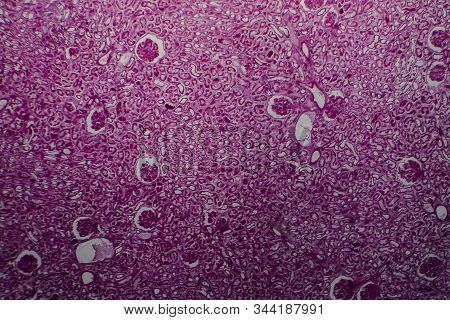 Histopathology Of Diffuse Sclerosing Glomerulonephritis, Light Micrograph, Photo Under Microscope