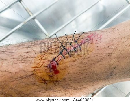 Wound Sutures In The Legs Of Patients In The Hospital.